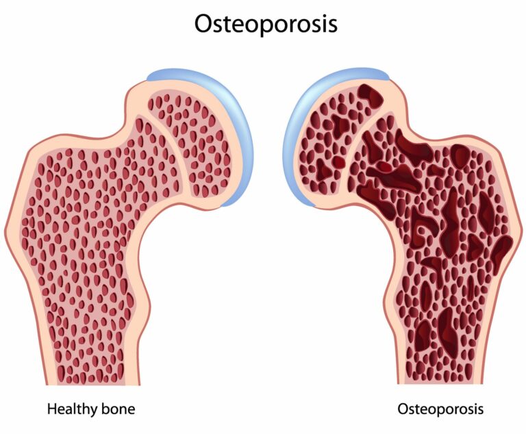 Osteoporosi