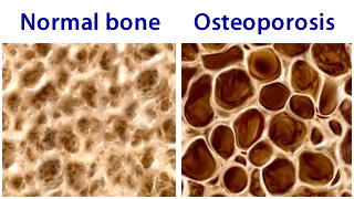 osteoporosi