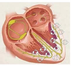 fibrillazione ventricolare