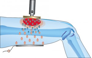 tecarterapia capacitiva