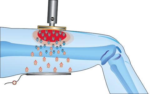 tecarterapia capacitiva