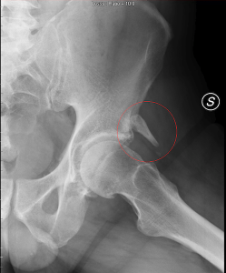 calcificazione anca