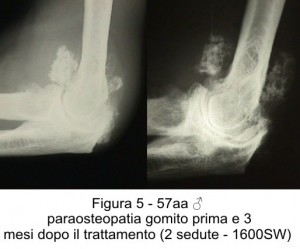 calcificazione gomito