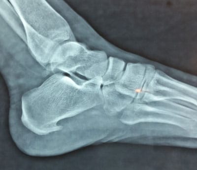 spina calcaneare rx