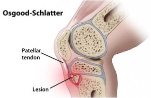 Osgood-Schlatter