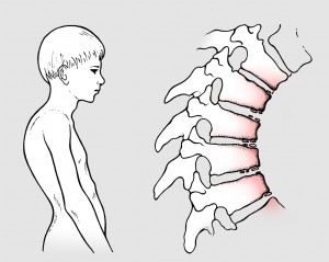 osteocondrosi