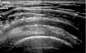 ecografia calcificazione spalla