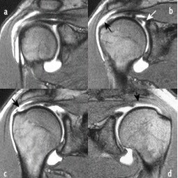 risonanza calcificazione spalla