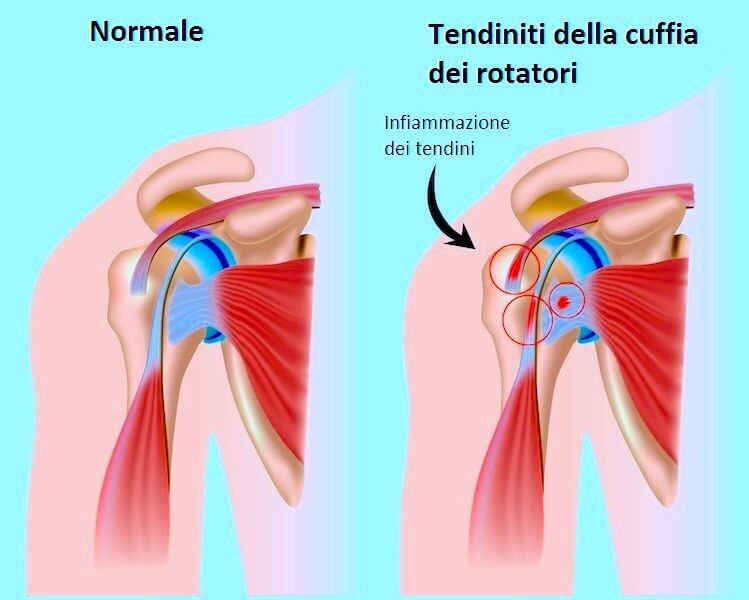 La Cuffia Dei Rotatori Cosa E Come Curarla Una Guida Completa