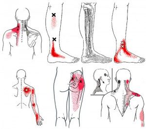 mappa trigger point