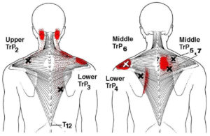 nervo accavallato trapezio