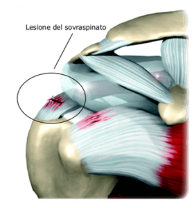 rottura cuffia-dei-rotatori