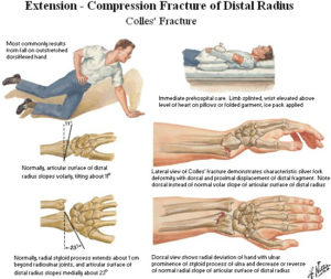 frattura di colles