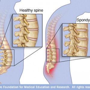 spondilite-anchilosante