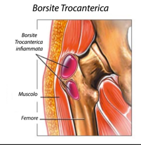 borsite trocanterica