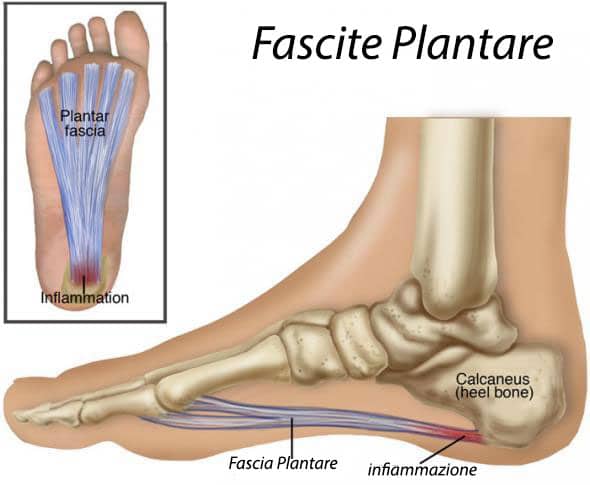 fascite plantare