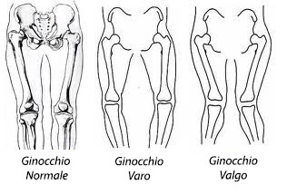 tipologie di ginocchio