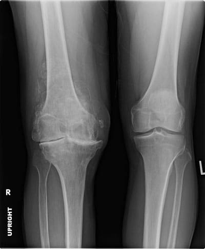 rx ginocchio artrosi