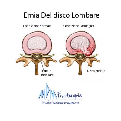 ernia del disco lombare