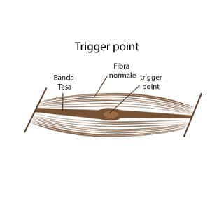 trigger point muscoli