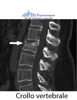 crollo vertebrale