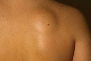 lipoma tra le scapole