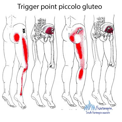 trigger point piccolo gluteo