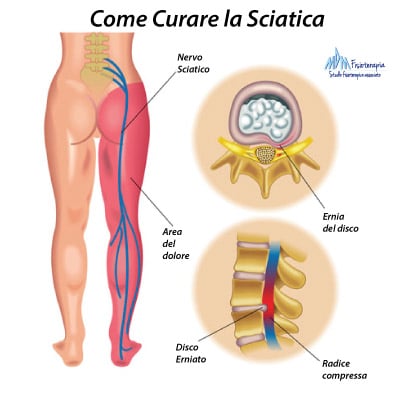 come curare la sciatica