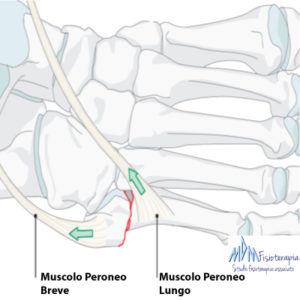 frattura quinto metatarso peroneo breve