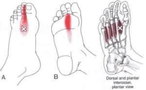 trigger point interossei piede