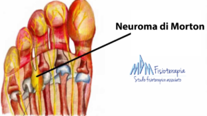 morbo di morton