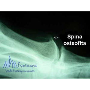 osteofiti alluce