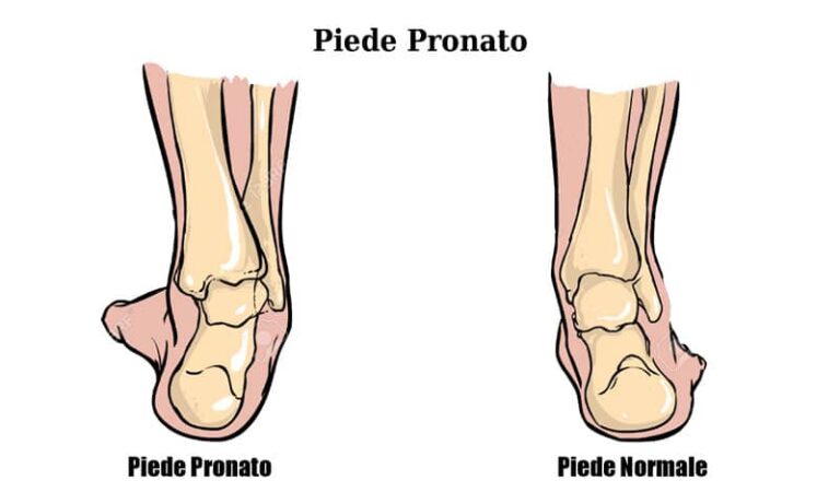 MASSAGGIO DEI PIEDI come rimedio per piedi dolorosi, deambulazione  faticosa, metatarsalgie, talloniti, tendiniti e fasciti plantari