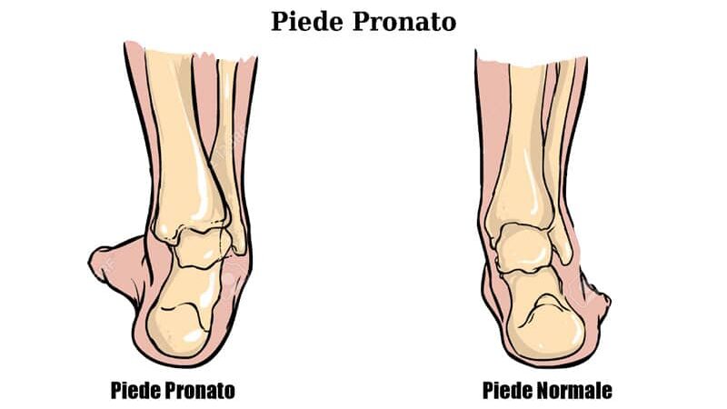 Piede Pronato | Una guida completa