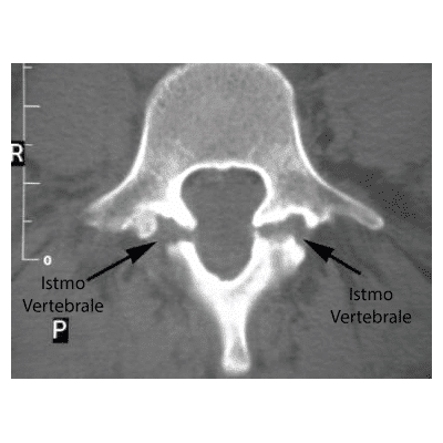 Rottura istmo vertebrale spondilolistesi