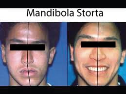 Mandibola storta