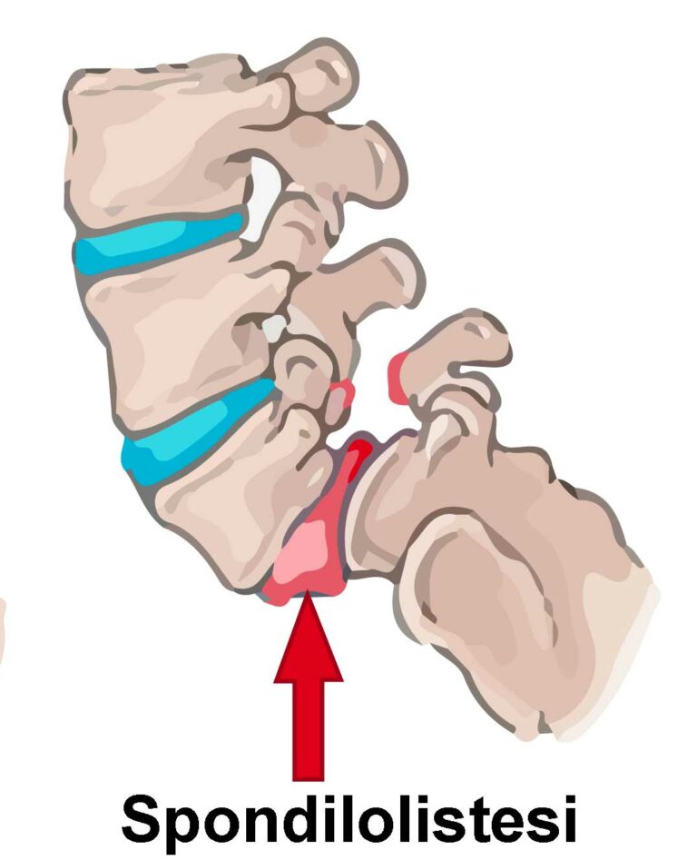 Spondilolistesi