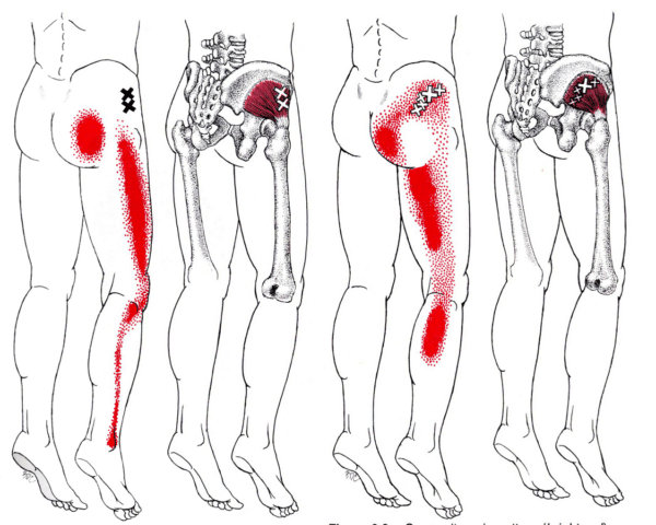 trigger point piriforme