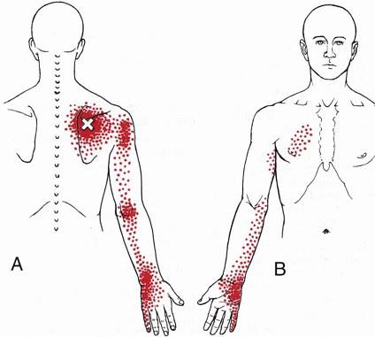 trigger point sottospinato