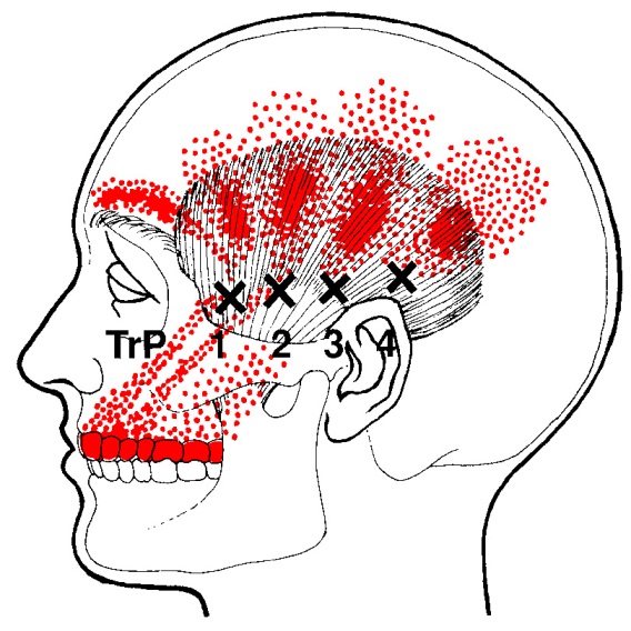 trigger point temporale