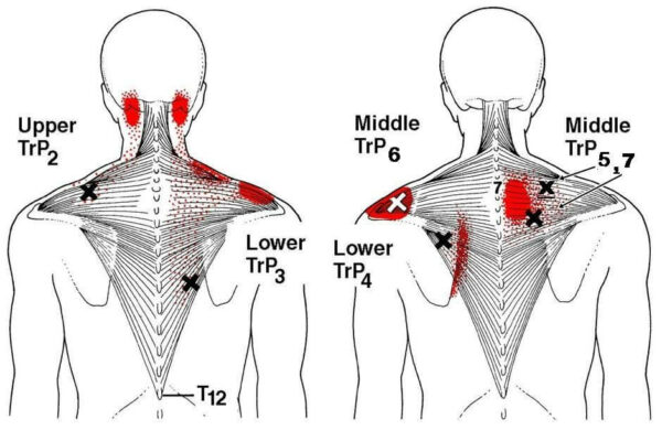 trigger point trapezio