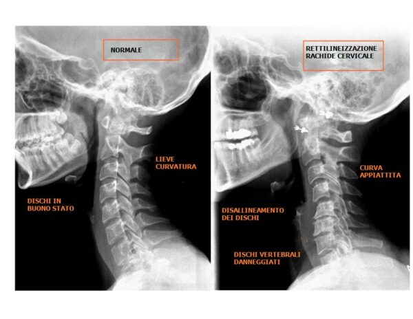 Sintomi cervicale Hai un dolore al collo e e ti stai cercando in giro per la rete: sintomi cervicale. Bene Oggi in questa guida analizzeremo in maniera approfondita le disfunzioni a carico del tratto cervicale soffermandoci in maniera completa sui Sintomi cervicale alla ricerca di possibili soluzioni per migliorare la tua condizione e allontanare i dolori che spesso limitano la qualità della vita. Le patologie a carico della colonna alta (consideriamo il tratto che va dall'occipite, fino a c7-d1) sono moltissime e colpiscono ogni anno circa 70 mila persone, con prevalenza del sesso femminile rispetto agli uomini. Sintomi Cervicale I sintomi del tratto cervicale possono essere suddivisi in 2 grandi categorie: Sintomi Ortopedici (muscolari e articolari) Sintomi vestibolari (Disturbi a carico del sistema vestibolare dell'orecchio) Sintomi Neurologici (Disturbi a carico del sistema neurologico centrale e sopratutto periferico) E' davvero molto importante fare questa distinzione in quanto in base alla "Famiglia" di appartenenza ci saranno degli interventi specifici molto efficaci che cercheranno di curare la cervicale, e risolvere i suoi problemi. Sintomi Ortopedici Quando parliamo di sintomi cervicali, ci rivolgiamo a un gruppo di patologie a carico di Vertebre, articolazioni intervertebrali (comprensive di legamenti) e sopratutto muscoli. Ognuno di noi ha un corredo di 7 vertebre cervicali che con la loro sovrapposizione creano una curva chiamata Lordosi cervicale. Se per motivazioni di natura traumatica (colpo di frusta) o di natura posturale (scoliosi, attività lavorative, genetica..) si modifica la condizione e la curva, è molto probabile che i rapporti articolari tra le singole vertebre, e i singoli muscoli siano alquanto disturbati ed è probabile che tale condizione porti inevitabilmente ad un dolore oltre che una limitazione articolare. I sintomi sono: Limitazione articolare con limitazione nel movimento: ci si accorge di questo sintomo chiedendo di rruotare la testa a destra o sinistra, oppure eseguendo movimenti di flesso - estensione. Si percepirà una vera e propria "barriera" articolare che limiterà l'escursione articolare e quindi il movimento. Tale limitazione potrà essere monolaterale o bilaterale Dolorabilità durante il movimento: è probabilmente il più frequente, e tale dolore potrà essere percepito sia durante tutto l'arco di movimento, sia ai gradi estremi. analizzare questa sensazione dolorosa, e come sopraggiunge fornisce spesso indicazioni molto interessanti per il terapista, che può quindi farsi un idea sul tipo di sintomo. Presenza di trigger point dolorosi nella muscolatura: i trigger point possono essere considerati come delle piccole porzioni di muscolo che rimangono contratte e generano un dolore locale e irradiato. Abbiamo scritto appunto una ottima guida ai trigger point Usura delle faccette articolari:Avere una colonna cervicale non perfetta porta inevitabilmente ad una usura precoce delle articolazioni (faccette articolari), con conseguente comparsa di fenomeni di Artrosi, e conseguente infiammazione. Sintomi Vestibolari Quando si parla di sintomi vestibolari, ci si riferisce a problemi legati all'orecchio, nei suoi organi interni. In realtà molto spesso sono presenti sintomi di equilibrio, come vertigini cervicali appunto, che simulano appunto tali disturbi. E' sempre buona norma fare diagnosi differenziale ed eseguire una visita dall'otorino risulterà essere fondamentale per non sbagliare l'obiettivo della terapia. Talvolta tali sintomi sono legati alla sindrome temporo mandibolare, che merita di essere approfondita eventualmente dal chirurgo maxillo facciale o dall'odontoiatra. Sintomi Neurologici I sintomi neurologici sono davvero tanti e spesso davvero molto invalidanti per la Violenza e il disturbo che sono in grado di scatenare. Generalmente tale sintomatologia è legata al fatto che nella postura scorrettavi è u sovraccarico delle strutture molli come i dischi intervertebrali con conseguente protrusione ed ernia cervicale che possono causare una compressione a carico dei nervi con quindi sintomi neurologici periferici. Altra causa di questi sintomi è certamente una deformazione della struttura ossea delle vertebre (crolli, artrosi, traumi) comprimendo i nervi e causando dolore. I sintomi sono: Mal di testa: comparsa di dolore che può essere intermittente, oppure continuo Sbandamenti Vertigini: spesso la cervicale determina sintomi come le vertigini che possono rivelarsi molto pericolose proprio perchè possono provocare cadute e fratture con conseguenze anche gravi. Brachialgia: se i nervi vengono irritati è possibile che si verifichino una serie di sintomi periferici lungo il decorso del plesso brachiale, oltre a problemi sensitivi con caldo, freddo e insensibilità cutanea lungo il braccio. Talvolta però il dolore può semplicemente limitarsi al collo, o subito sul lato nella zona del trapezio.