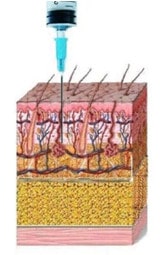 mesoterapia ago