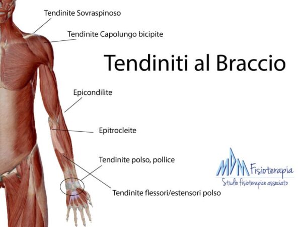 Tendiniti braccio