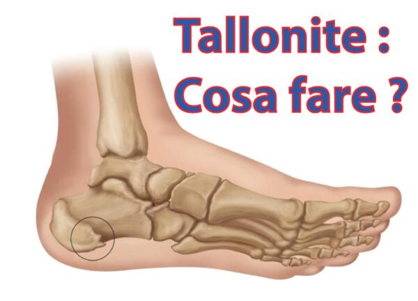 tallonite cosa fare