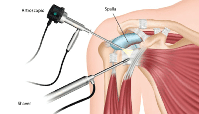 artroscopia spalla