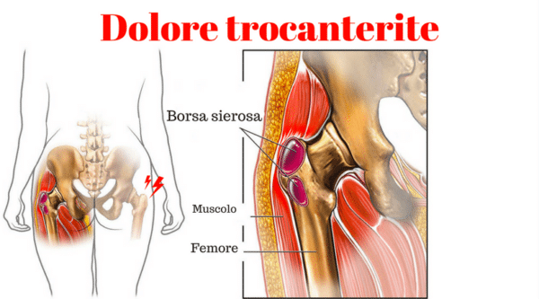 dolore trocanterite