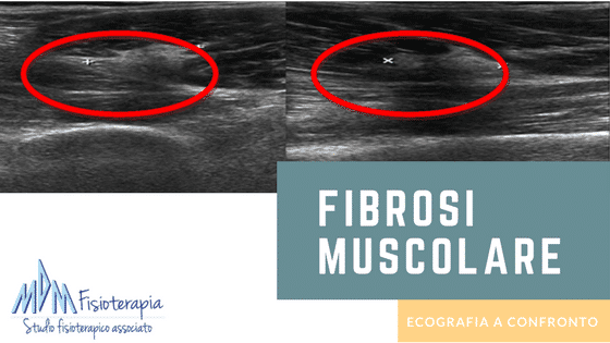 fibrosi muscolare