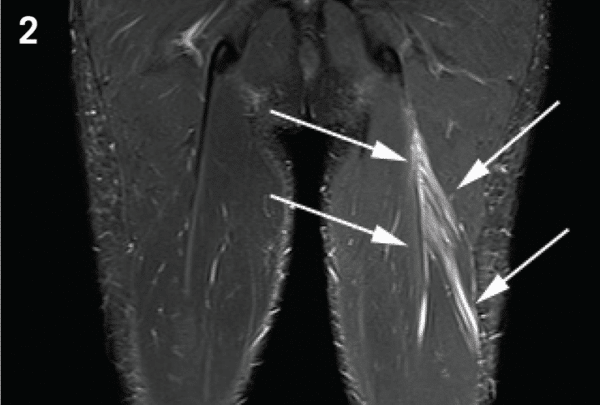 lesione muscolare risonanza