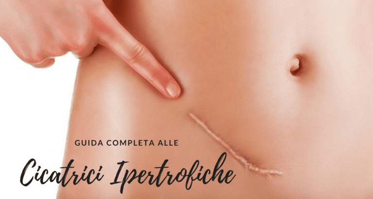 Cicatrice Ipertrofica | Cosa è e come migliorare l’aspetto